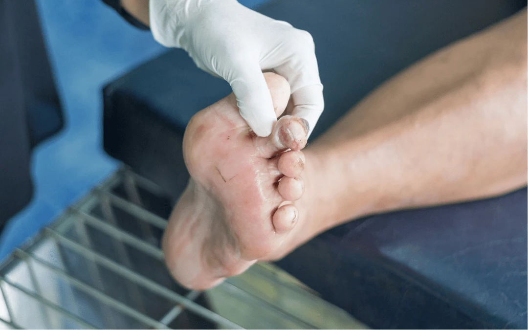 Leg With Wound On Toe And Hand With Glove Checking On Wound