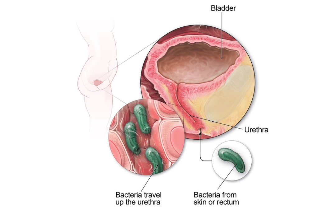 Simple Illustration Of Ecoli Bacteria In Urinary Tract System Indicating Urinary Tract Infection