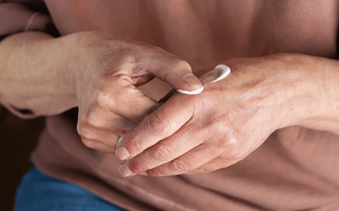 Upclose Of A Woman Hand Rubbing White Cream Onto Her Joints